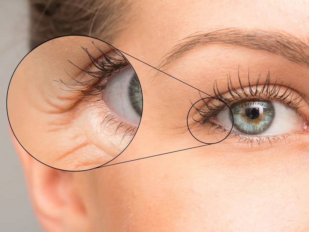 Filler treatment in lower face (marionette lines)