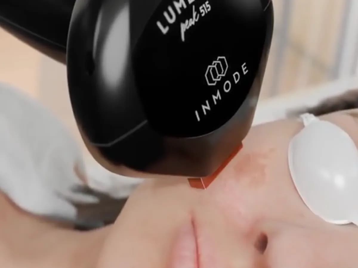 Close-up of face treated with IPL